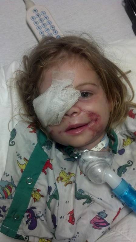 A menina perdeu o olho direito no ataque de um pitbull