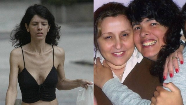 A ex-modelo Josi Campos, em 2004, com 35 quilos, e hoje ao lado da médica na clínica onde está internada há dez anos