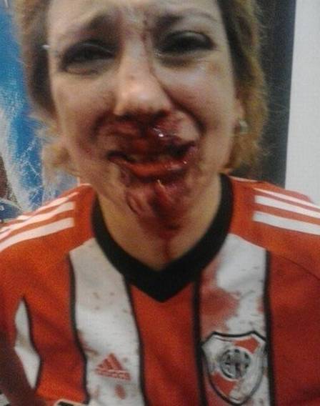A jovem publicou uma foto dos ferimentos após a agressão