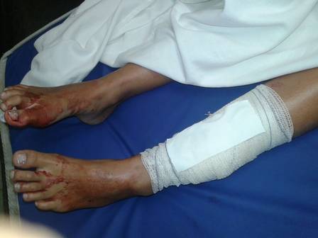 O ferimento na perna de Lilian