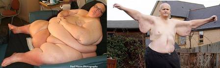 Paul Mason era o homem mais gordo do mundo e ficou com excesso de pele após a cirurgia