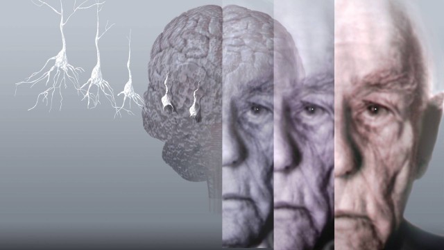 Áreas cerebrais reduzidas podem indicar início do mal de Alzheimer