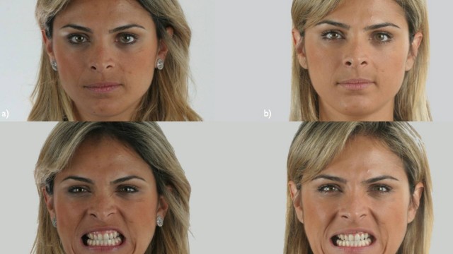 Antes e depois de paciente: tratamento suaviza rugas e deixa o rosto mais simétrico