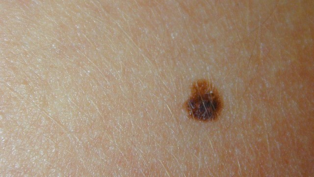 Cerca de 20% a 40% dos cânceres de pele estão relacionados à pintas preexistentes