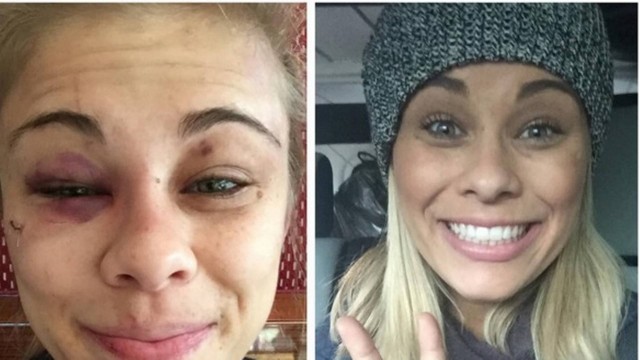 A lutadora fez uma comparação com fotos do seu rosto depois da última luta com uma atual