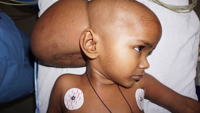 A menina Renu, de 4 anos, tinha um tumor do tamanho de uma bola de futebol na cabeça