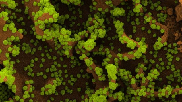 Micrografia eletrônica de varredura colorida de uma célula (marrom) fortemente infectada com partículas do coronavírus (Sars-CoV-2, em verde), isolada de uma amostra de paciente