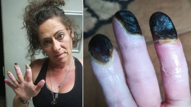 Melinda Jansen van Vuuren mostra os dedos afetados por doença rara ligada ao tabagismo