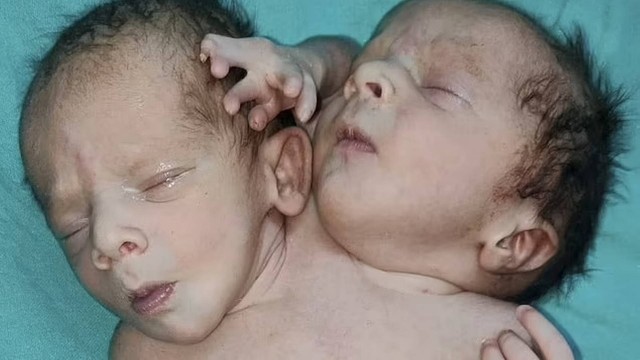 Gêmeos siameses nasceram com duas cabeças, três braços e dois corações na Índia.