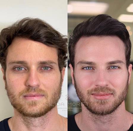 Antes e depois da harmonização facial do ex-BBB Lucas Bissoli