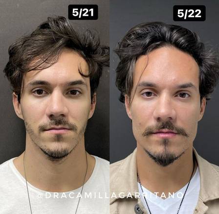 Ex-BBB Eliezer antes e depois da nova harmonização facial