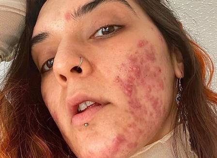 'Apreciação da acne': influencer defende pele com diferentes texturas e se exibe com espinhas