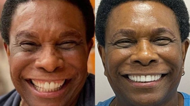Antes e depois do sorrido de Neguinho da Beija-Flor