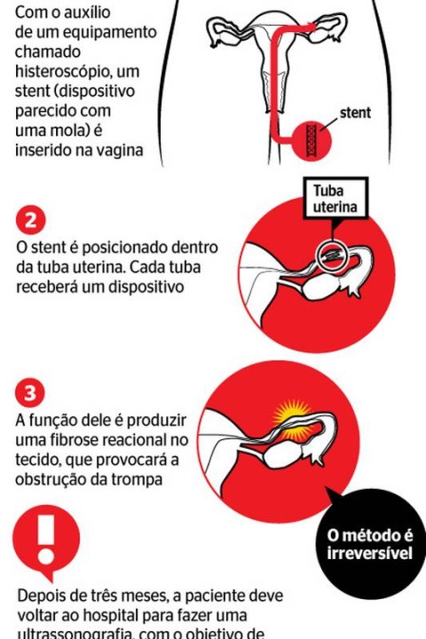 Laqueadura: do pedido até a cirurgia, entenda o processo em seis