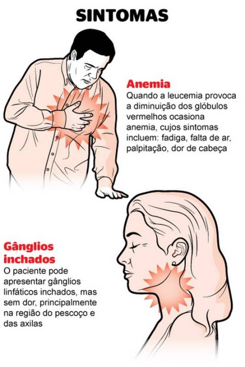 sintomas de leucemia