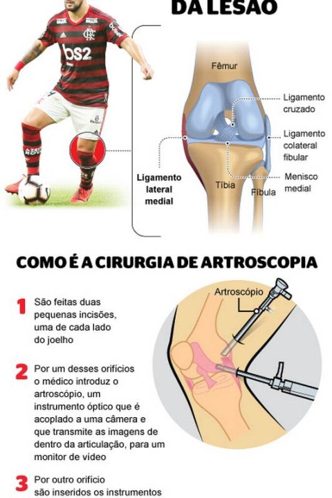 Nino tem entorse leve no joelho e fará tratamento para jogar a