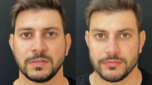 Harmonização facial em homens: veja o antes e depois de brothers