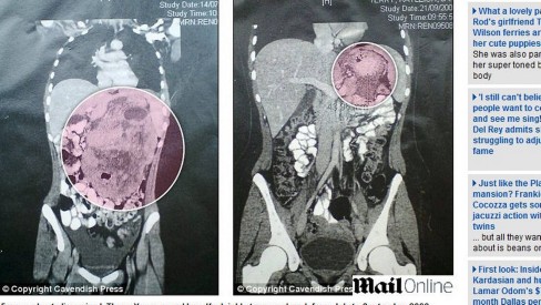 Garota de 12 anos tem tumor do tamanho de uma melancia - Alagoas